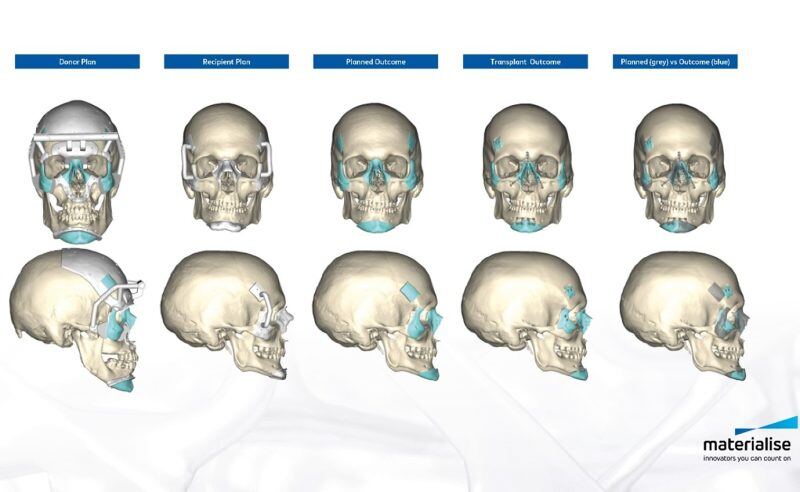 3D Technologies Support World’s First Successful Double Hand and Face Transplant – Materialise 3D Technologies Support World’s First Successful Double Hand and Face Transplant - Materialise